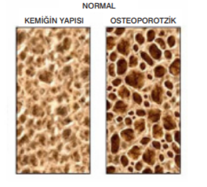 Kalsiyum ve Osteoporoz İlişkisi - Kemik Yapısı